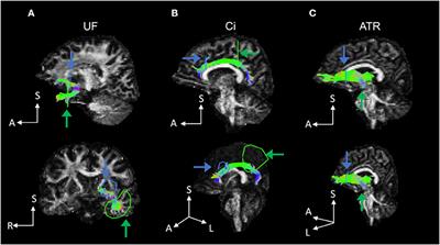 Adverse Childhood Experience Is Associated With Disrupted White Matter Integrity in Autism Spectrum Disorder: A Diffusion Tensor Imaging Study